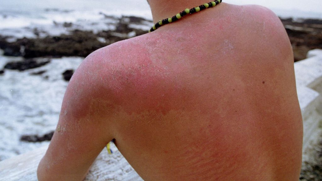 Sunburn at high altitude a guide to recover