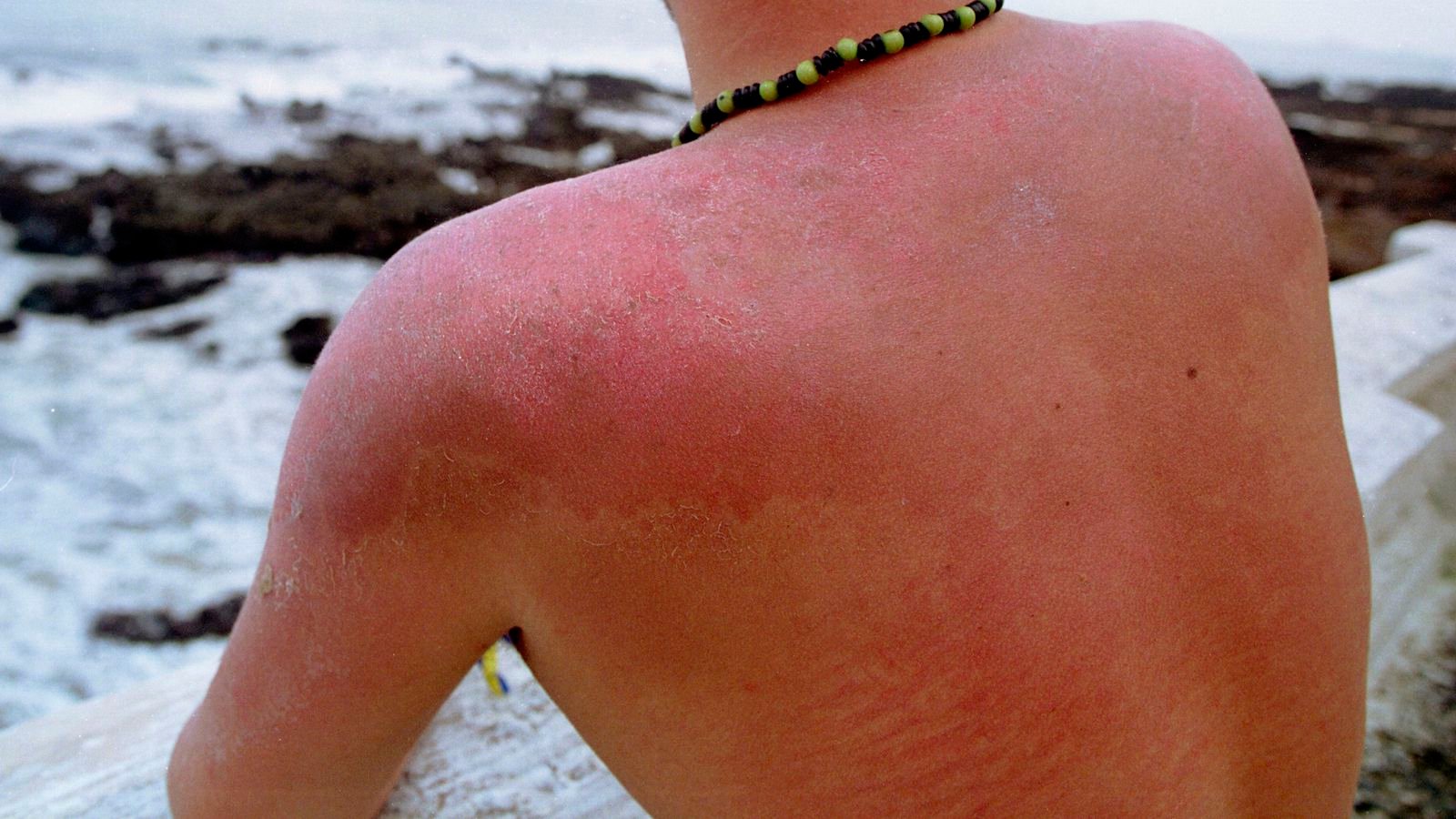 Sun Burn Injuries Sunburn Recovery and Care at High Altitudes: A Guide - Kashmiriat